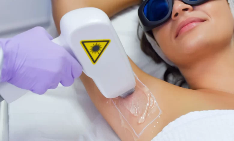 The 5 Most Significant Benefits of Laser Hair Removal
