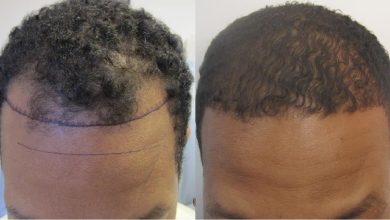 textured hair transplant cost